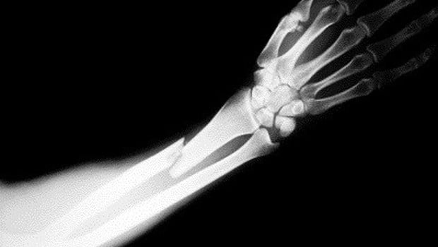 X-ray of a Broken Arm